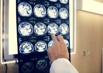 Brain CT scan x-ray film