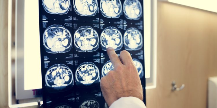 Brain CT scan x-ray film