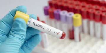 Kolumbusz előtt jelen volt Európában a szifilisz